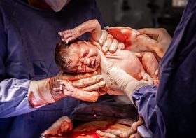 Inducción del parto; Actualización Guías NICE de Reino Unido